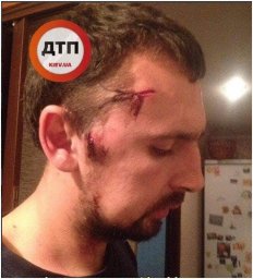 В Киеве мужчину ограбили и нанесли ему травмы
